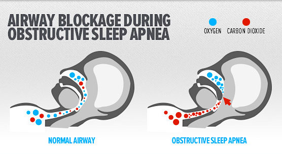 Sleeping but still feel tired? It might be sleep apnea.