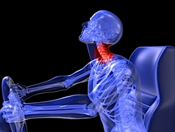 Car accident resulting in Whiplash